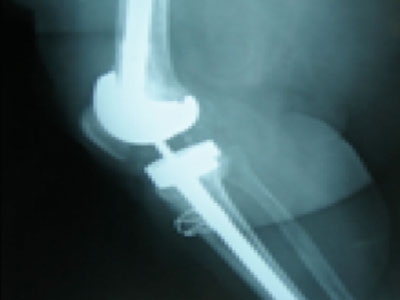 El transplante de aloinjerto de aparato extensor en prótesis de revisión de rodilla