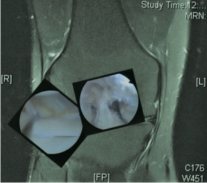 La Rehabilitación en las Lesiones del Complejo Posterolateral de La Rodilla