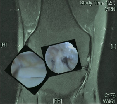 La Rehabilitación en las Lesiones del Complejo Posterolateral de La Rodilla